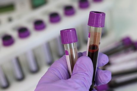 Kumihansikoitu käsi pitetlee kahta verinäyteputkiloa laboratoriossa